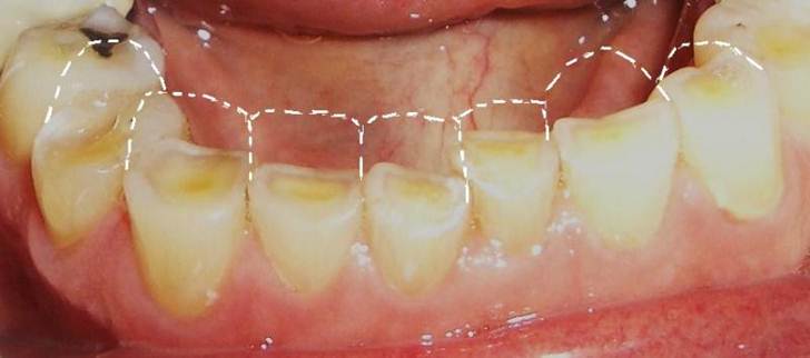 Lifexpe LXP Life experiencing teeth ache tooth erosion
