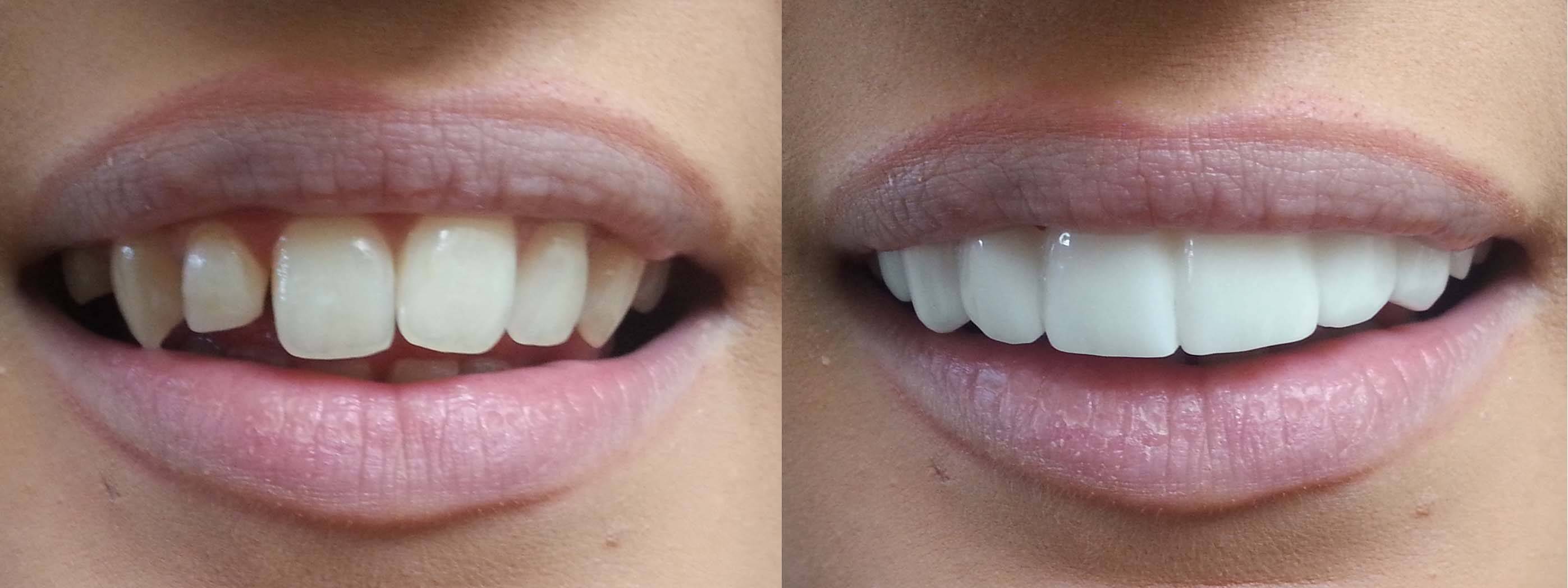Lifexpe LXP Life Experience at the dentist clip on veneers teeth tooth bleaching shades before and afters