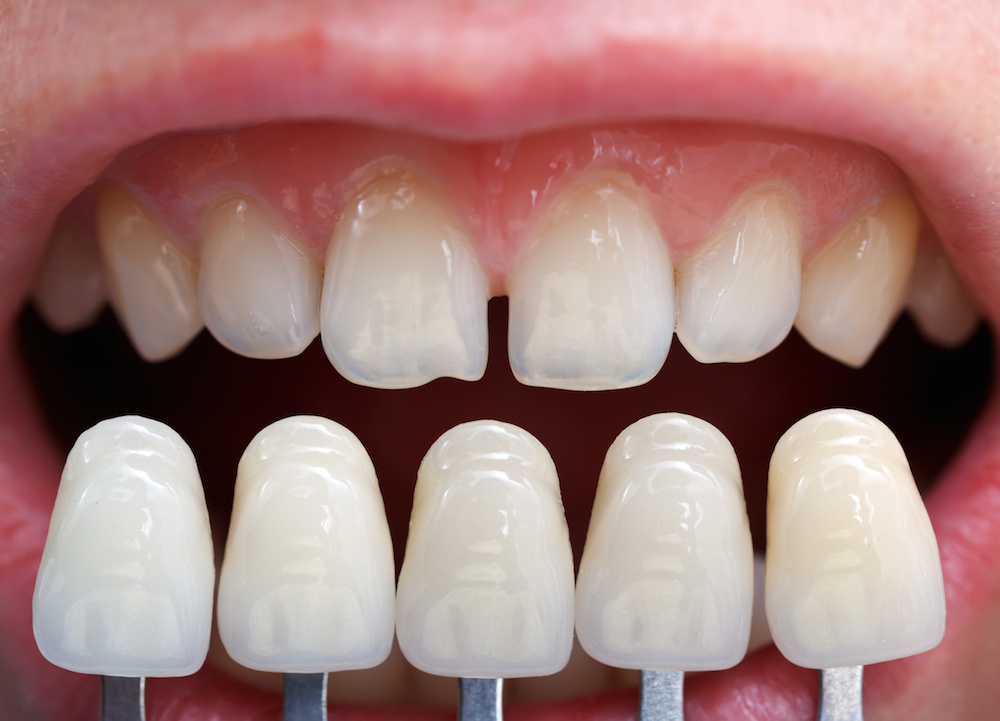 LXP Lifexpe Life Experience pros and cons of dental veneers costs